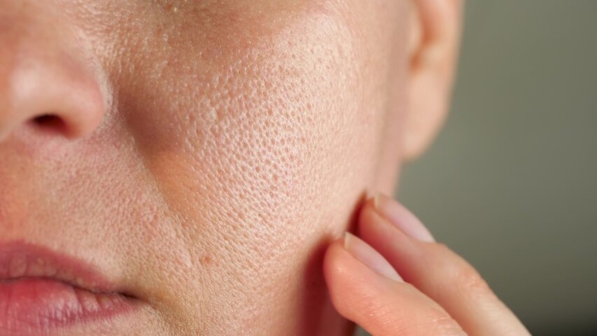 Large pores